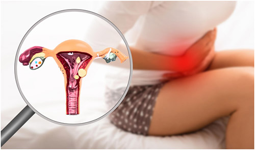 #LunesOtra Vez: Salud menstrual; endometriosis.
